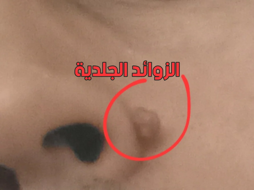الزوائد الجلدية